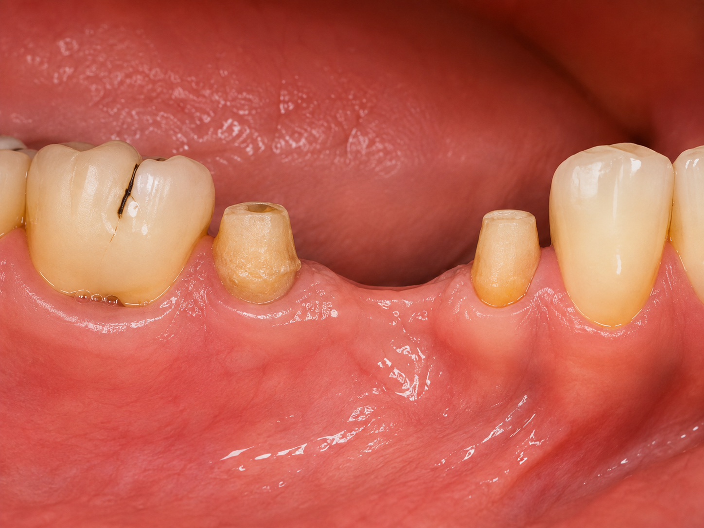 Crowns & Bridges before treatment